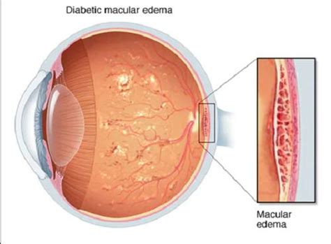 Diabetic Macular Edema Causes Symptoms And Treatment