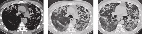 Chest Ct In A Patient With A Course Of Viral Pneumonia Ct2 Axial Ct Download Scientific