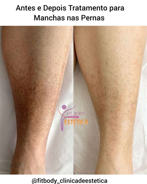 Borbulhas Nas Pernas Angioma Rubi: O Que é, Características, Causas