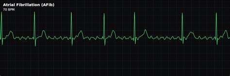 atrial fibrillation afib ecg rhythm telemetric pro