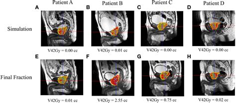 Frontiers Urethral Interfractional Geometric And Dosimetric