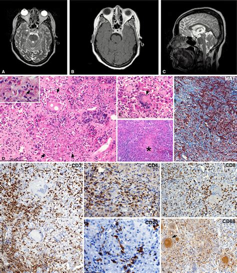 Ac Mri Show A Sellar Mass Heterointense On T Wi A With