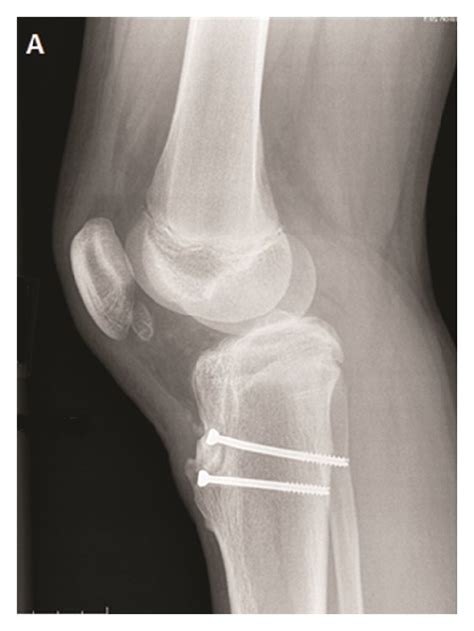 Three Years After Internal Fixation A Genu Recurvatum Deformity Is