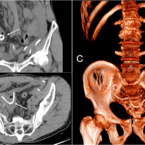 Computed Tomography Ct Scan Of The Abdomen And Pelvis Shows The