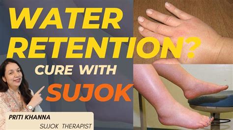 Water Retention Treatment By Sujok Therapy Priti Khanna Youtube