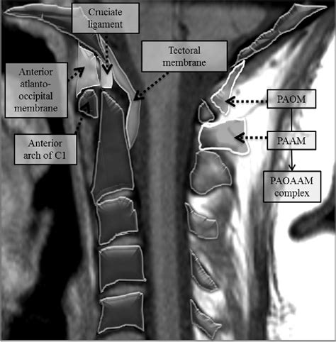 Figure From Diagnostic Utility Of Increased Stir Signal In The