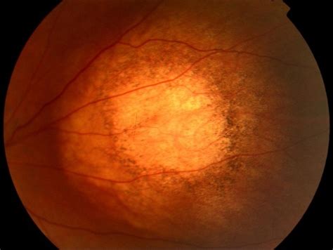 Choroidal Nevus Amelanotic The Retina Reference