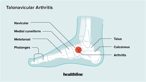 Talonavicular Arthritis Symptoms Causes Diagnosis Treatment