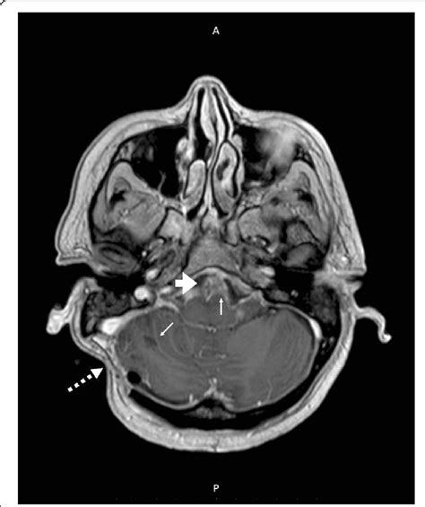 Axial Magnetic Resonance Imaging (MRI) at the posterior fossa level ...