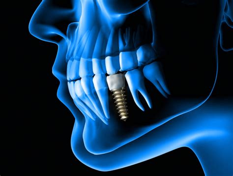 Qu Es La Osteointegraci N De Los Implantes Dentales Estudi Dental