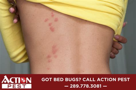 Bed Bugs Rash Treatment