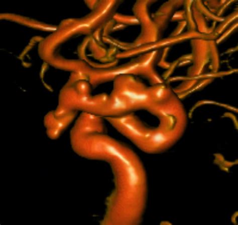 Aneurysm Vessel Wall Imaging