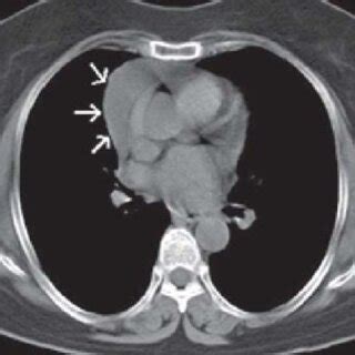 Follow Up Contrast Enhanced Computed Tomography Of Chest Showing