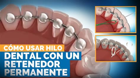 Cómo Usar Hilo Dental Con Un Retenedor Permanente Premier