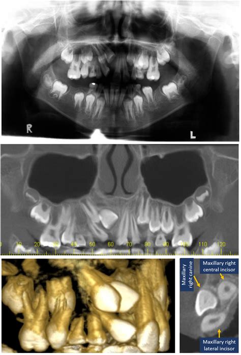 Orthodontic Correction Of Maxillary Canine Lateral Incisor