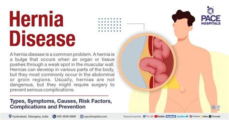 Hernia Symptoms Types Causes Complications Prevention 48 OFF