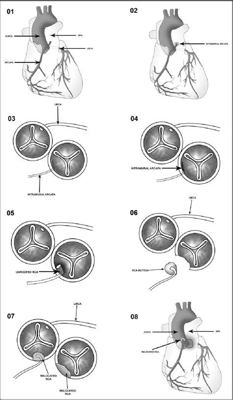 Figure 1 From Intramural Anomalous Right Coronary Artery From The Main