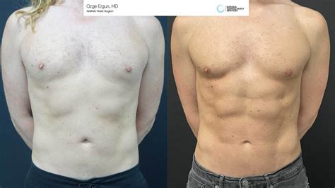 Vaser Liposuction Plastic Surgery Before And After Photos