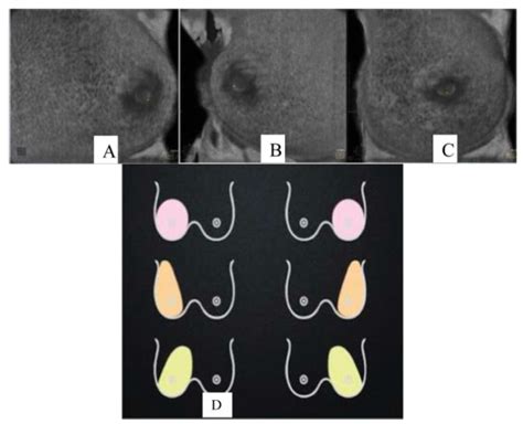 Scielo Brasil Comparison Of Automated Breast Ultrasound And Hand