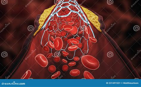 Atheroma Plaque Inside Artery Royalty Free Illustration Cartoondealer