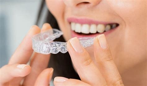 Find Out Why Some Invisalign Users Need Attachments