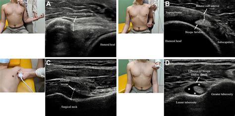 Correlation Of Ultrasound Findings With Clinical Stages And Impairment In Adhesive Capsulitis Of