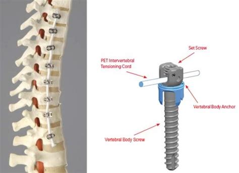 The Tether™ Vertebral Body Tethering System H190005 Spinal Fusion Spinal Surgery Bone