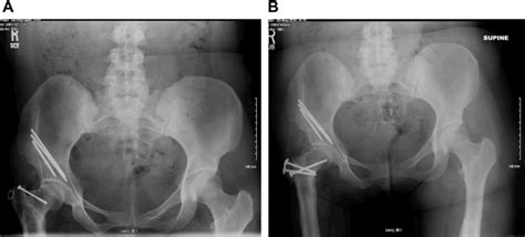 Hip Preservation Paley Orthopedic And Spine Institute