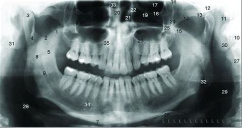 Radiology Landmarks Panoramic Diagram Quizlet
