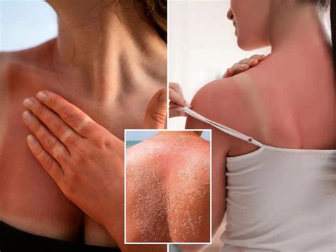 Sunburn Or Sun Poisoning How To Tell If Youve Gotten Too Much Sun