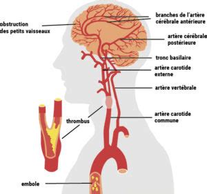 L Avc Accident Vasculaire C R Bral Ffc