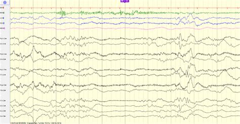 Learn To Read Eeg With Practice Questions Nowyouknow Neuro