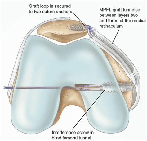 Medial Patellofemoral Ligament