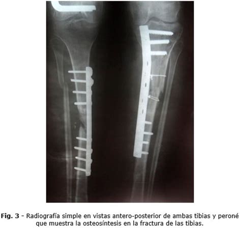 Osteosíntesis interna en fracturas múltiples Cuní Frontela Revista