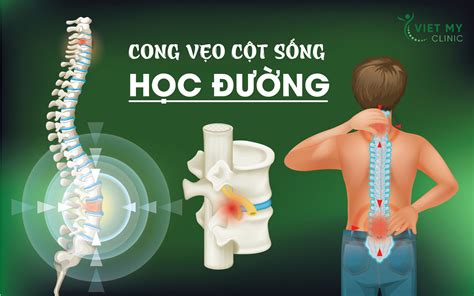 Cong VẸo CỘt SỐng HỌc ĐƯỜng TÌnh TrẠng ĐÁng BÁo ĐỘng HiỆn Nay