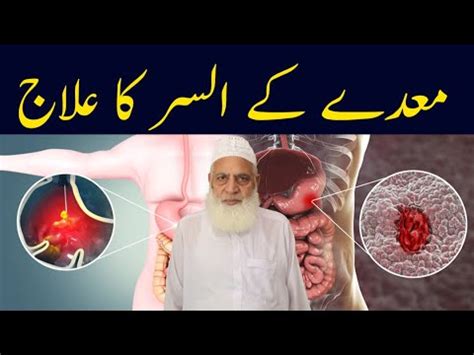 Alsar Ka Ilaj Stomach Ulcer Disease Dr Muhammad Arshad Jawed