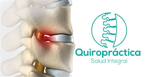 Qu Es Una Subluxaci N Vertebral Quiropr Ctica C Diz Salud Integral