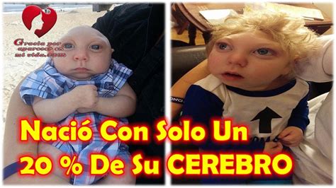 Recuerdas Al Bebe Que Nació Sin Una Parte De Su Cráneo Mira Como Luce