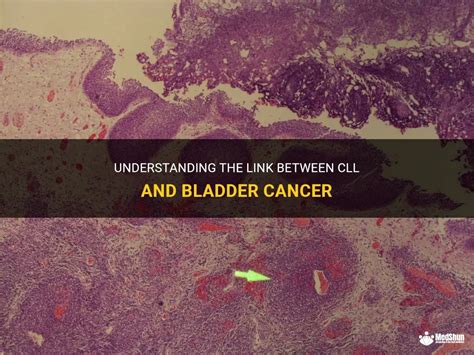 Understanding The Link Between Cll And Bladder Cancer Medshun