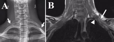 Case 2 A Frontal Radiograph Showing Bilateral Cervic Open I