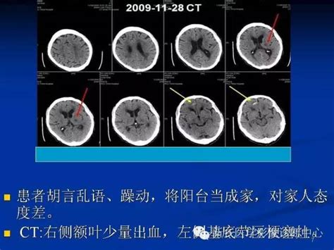 【ppt】脑小血管病影像学研究 影像ppt