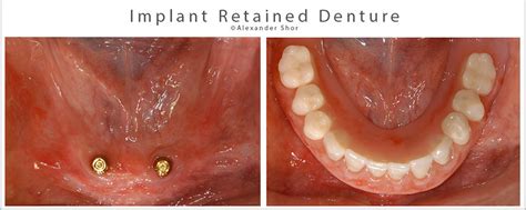 Types Of Snap In Dentures Veryheaven