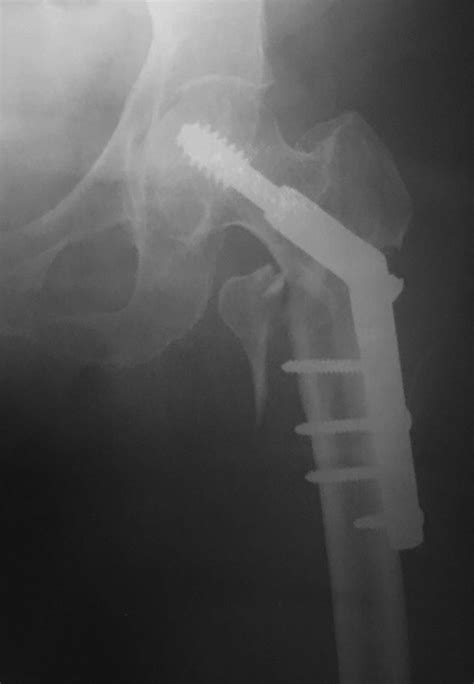 Post Op Anteroposterior Plain Radiograph Displayed Reduction And Download Scientific Diagram