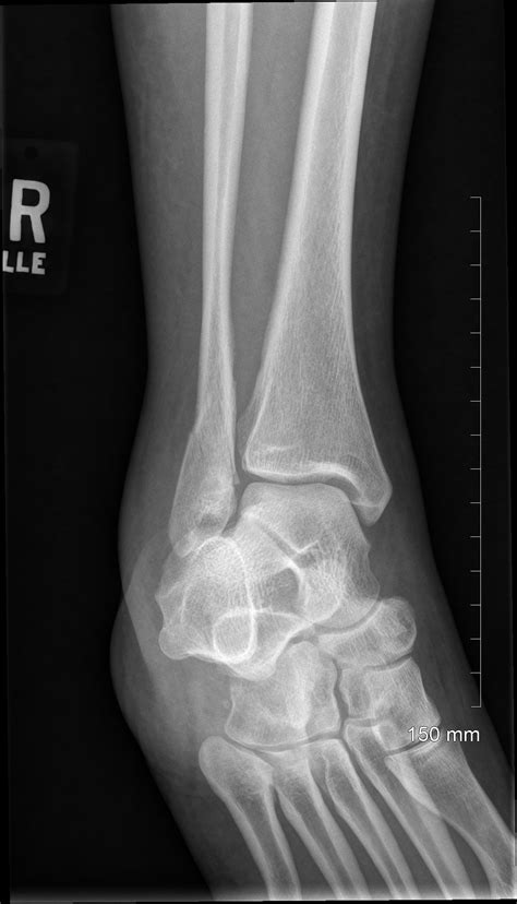 Ankle Fracture Broken Ankle Arthroscopy Surgery Atlanta Ga