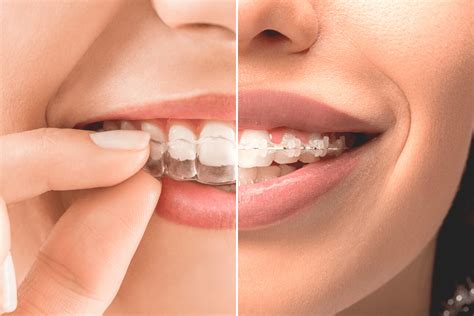 Brackets Transparentes Vs Invisalign