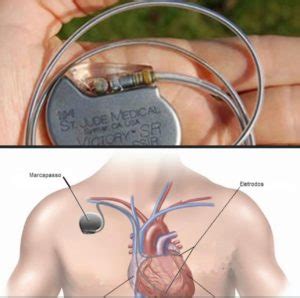 Saiba Mais Sobre O Marcapasso Dr Andr Gasparoto Cardiologista