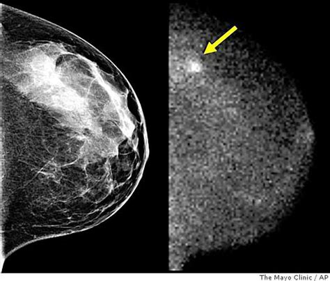 New Cancer Tool For Women With Dense Breasts