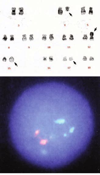 A G Banded Karyotype Of The Bone Marrow Cells Showing T Q P