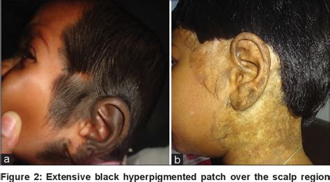 Figure 2 From Giant Congenital Melanocytic Nevi Successfully Treated