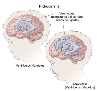 Hidrocefalia Aemc Chiari